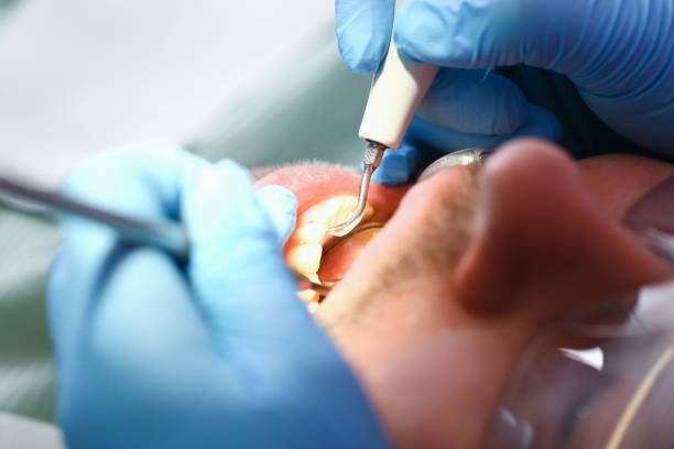 Best Emergency Wisdom Teeth Removal in Eagle, WI